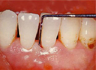 歯周病（重度）