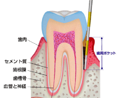 歯周ポケット測定（６点法または１点法）